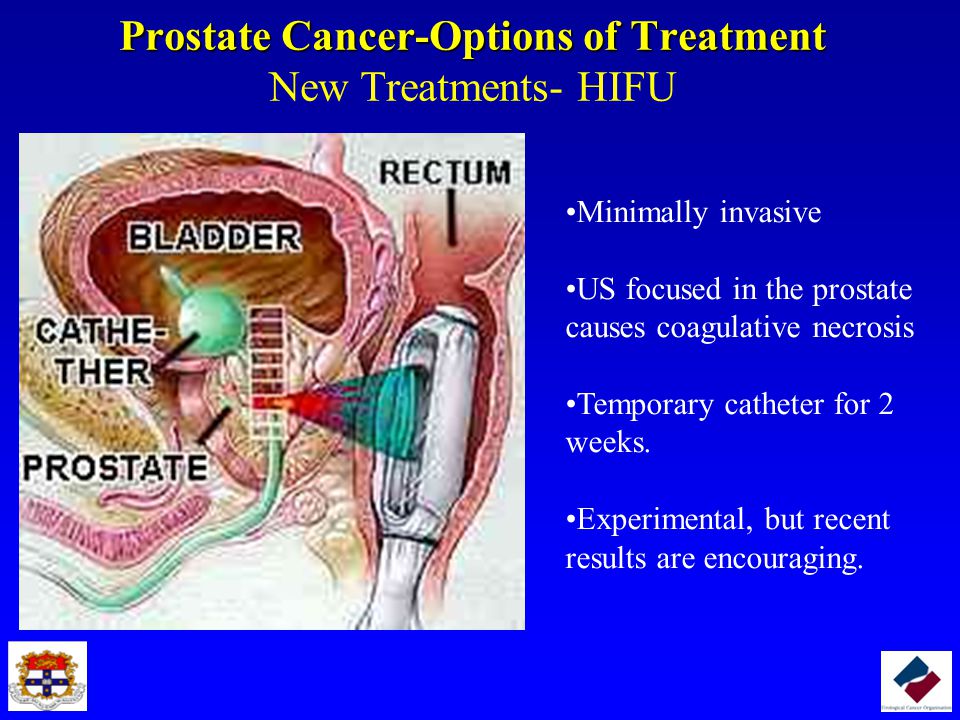 How successful is hifu for prostate cancer